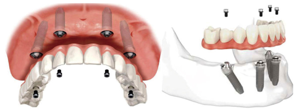 All-on-4种植牙 All-on-4种植牙