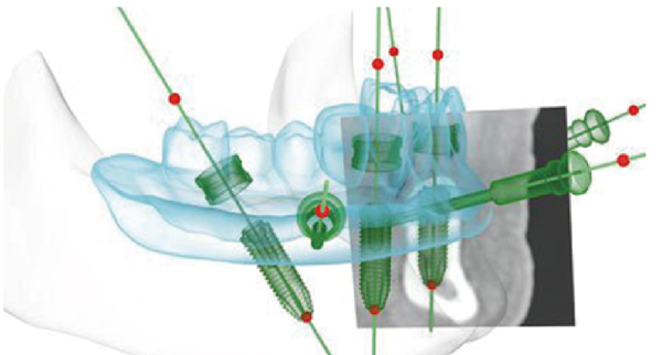 三维种植导板定位种植体位置 三维种植导板定位种植体位置
