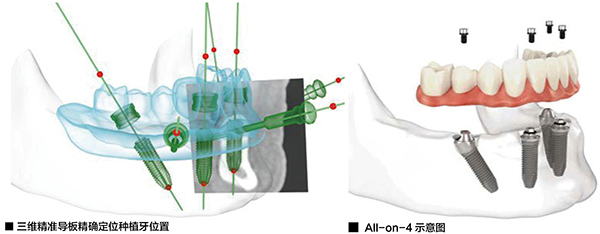 三维种植导板和All on 4种植牙 三维种植导板和All on 4种植牙