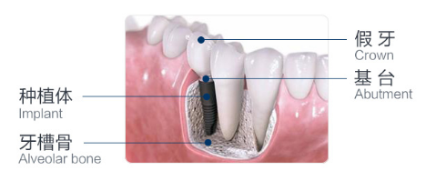 种植牙示意图—苏州美奥口腔 种植牙示意图—苏州美奥口腔