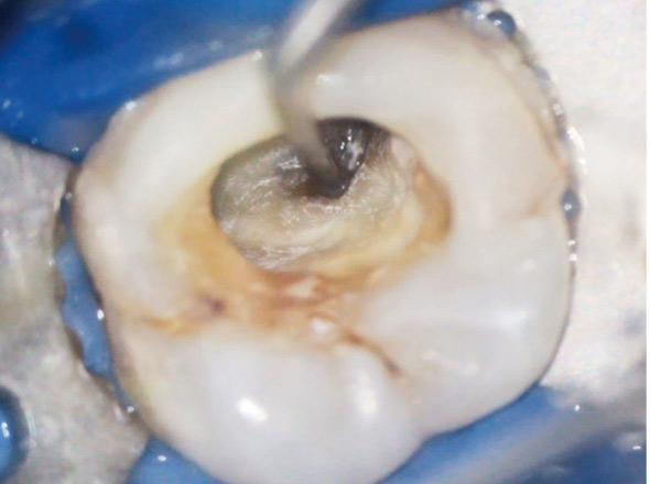 显微镜下的根管清晰图 显微镜下的根管清晰图