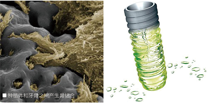 种植体和牙骨 种植体和牙骨